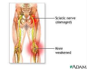 sciatica-adam.jpg